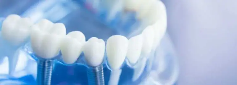 Everything-you-need-to-know-about-dental-implant