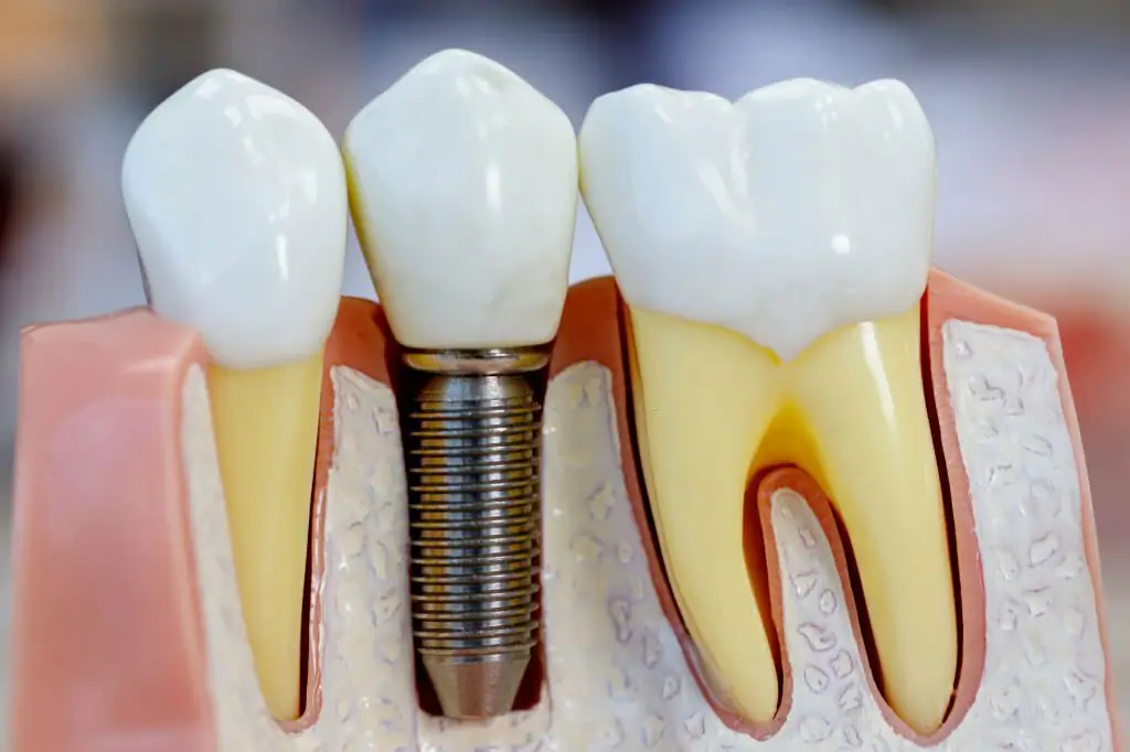  Everything You Need to Know About Dental Implants in Keller, TX_2