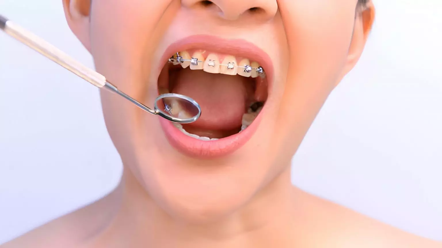 The Ultimate Guide to Orthodontic Treatment in Keller, TX_2