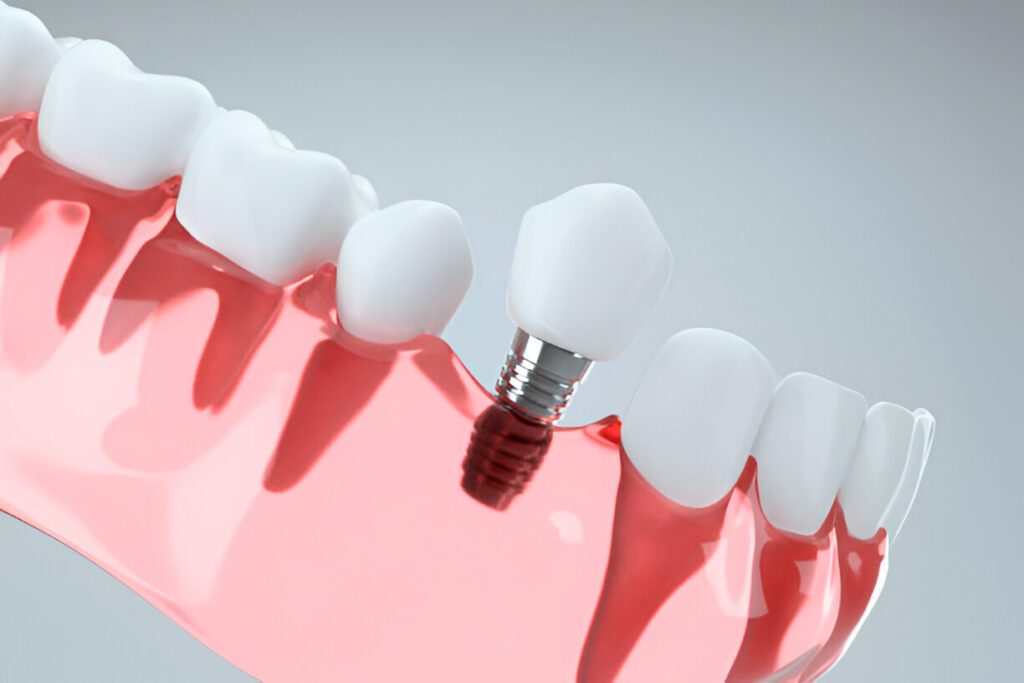 How to Care for Your Dental Implants: Tips for Long-Lasting Results_3