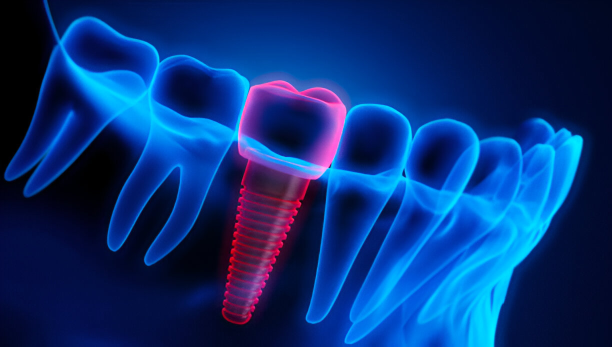 How to Care for Your Dental Implants: Tips for Long-Lasting Results_FI