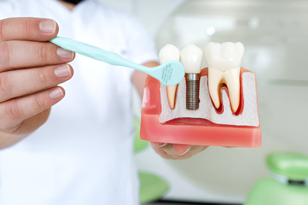 Dental Implants in Keller, TX: Why Keller Family Dental is a Top Choice_1