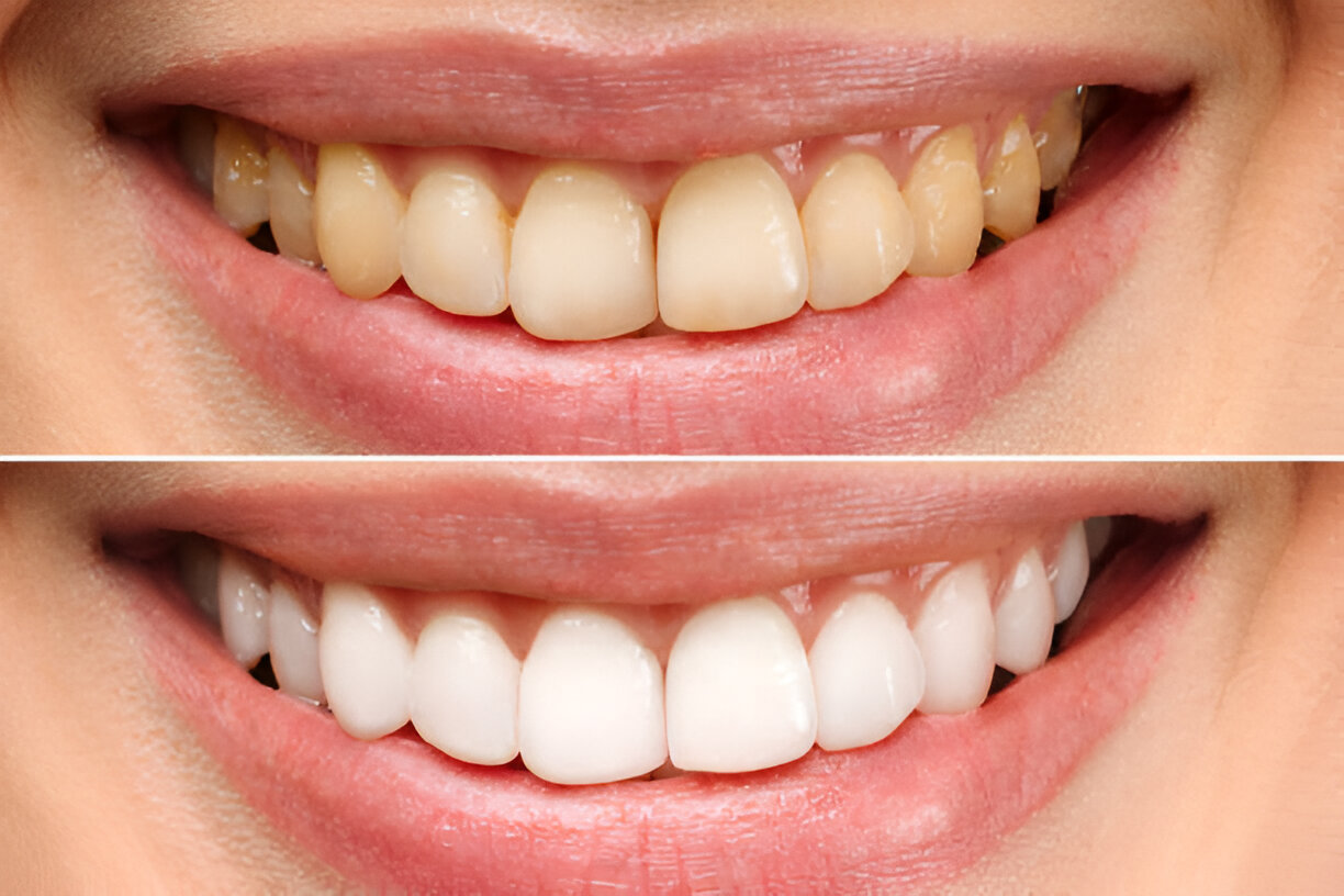 Your Guide to Teeth Whitening in Texas: Services Offered by Keller Family Dental_FI